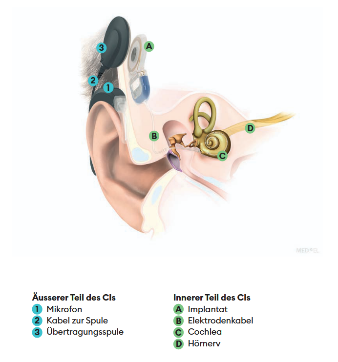 Schematische Darstellung eines Cochlea-Implantats